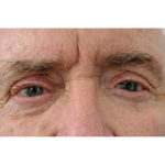 Artificial Eye Testimonial