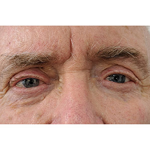 Ocularist Dwayne Collins artificial eye review from patient Barry Van Es